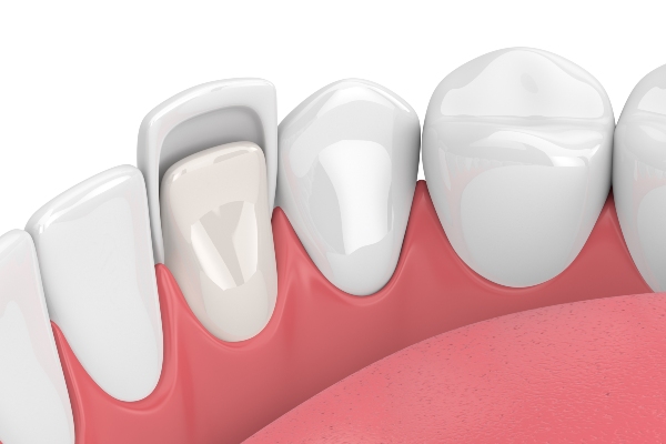 What Are The Different Types Of Dental Veneers?