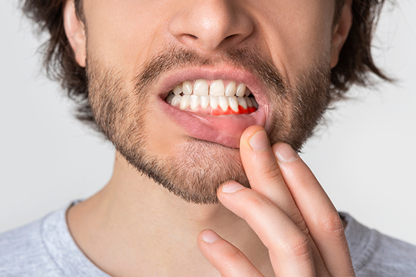 Bleeding Gums May Indicate A Dental Issue