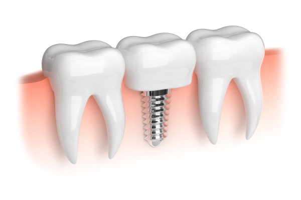 What Is Dental Implant Restoration?