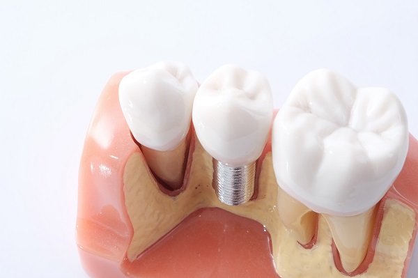 dental implants St. George, UT