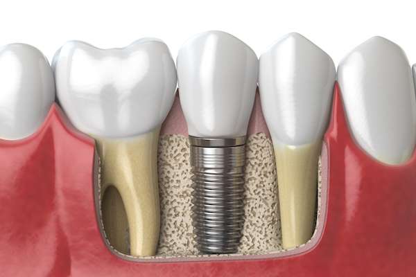 Dental Implants for Replacing Missing Teeth from About Dental Care in St. George, UT