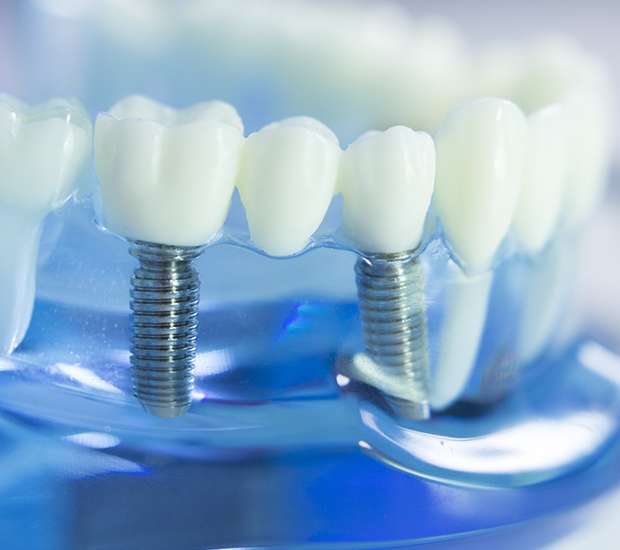 St. George Dental Implants