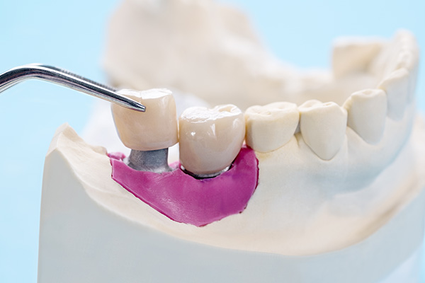 The Main Parts Of A Dental Implant Restoration
